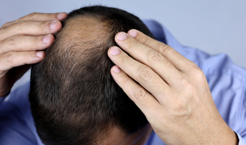 Hair Fall Treatment