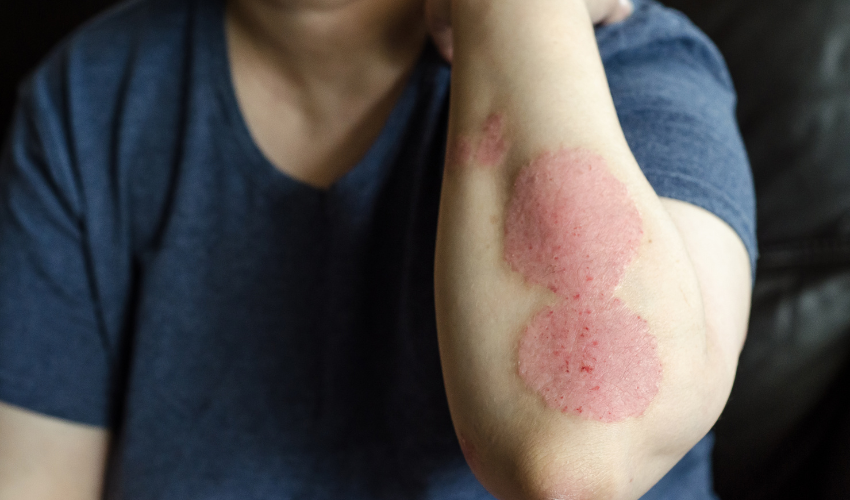 Psoriasis