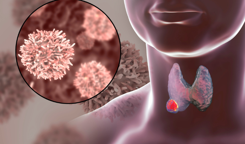 Thyroid Treatment
